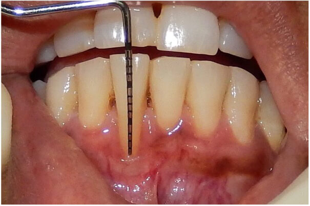 Before gingival recession